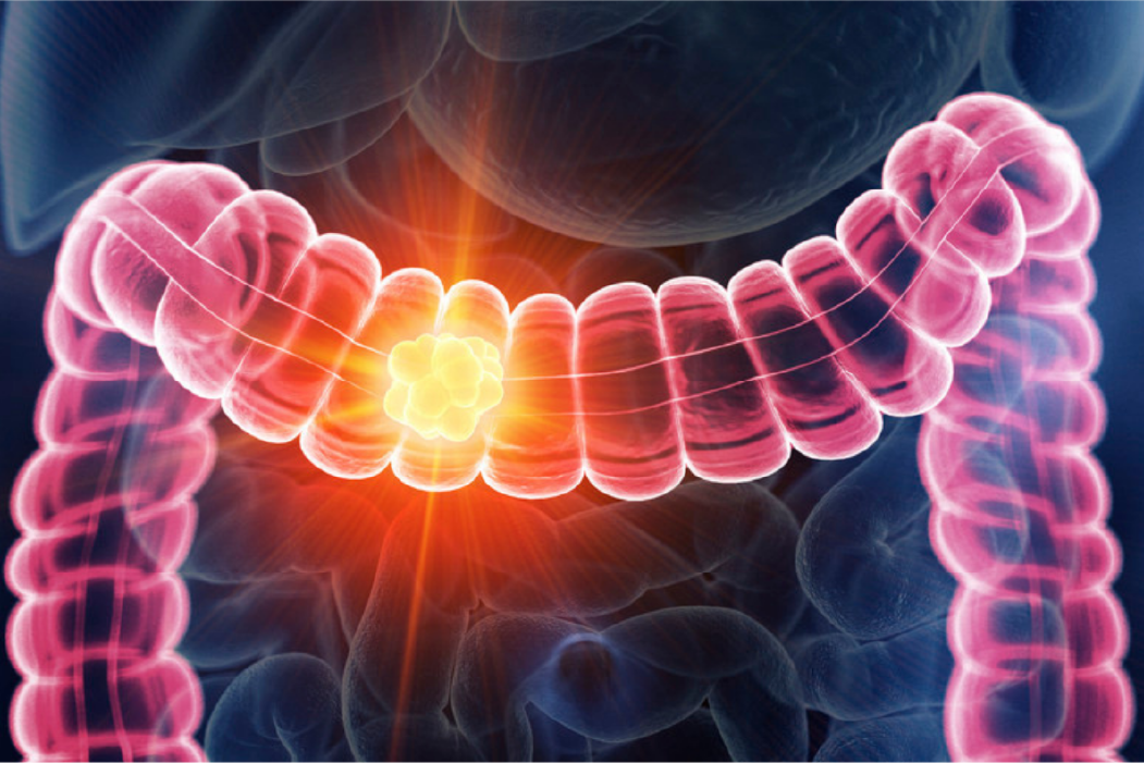 colorectal-cance_banner_pr(1).png