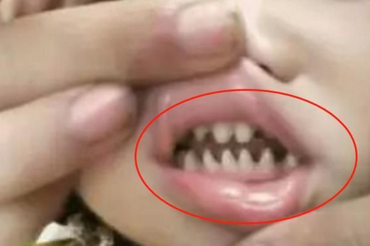 Con có hàm răng như "răng cá mập", bà mẹ hối hận vì nguyên nhân là do mình