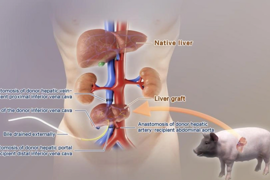 Cấy ghép thành công gan lợn cho bệnh nhân đầu tiên trên thế giới