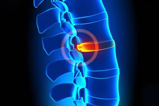 Điều trị không phẫu thuật giúp giảm đau lưng mãn tính và phục hồi chức năng