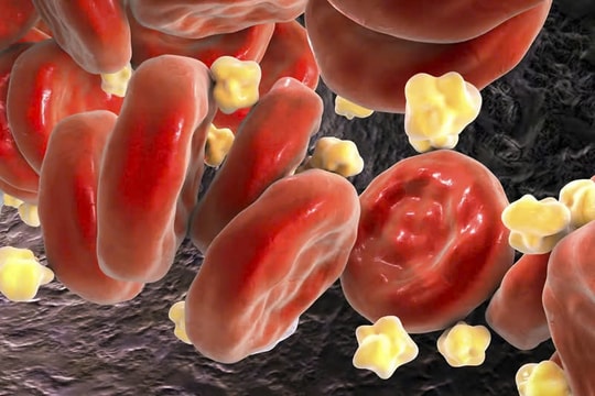 Phương pháp kết hợp thuốc uống giúp giảm gần 50% cholesterol xấu trong thử nghiệm lâm sàng