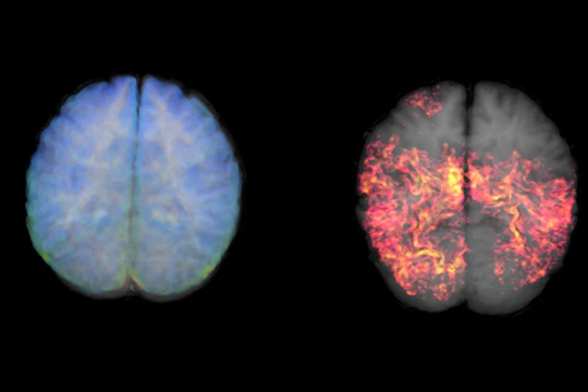 Xét nghiệm máu để hỗ trợ chẩn đoán Alzheimer‏