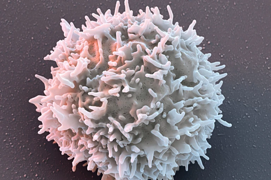 Liệu pháp CAR-T - hy vọng mới cho người mắc viêm khớp, lupus, viêm loét ruột