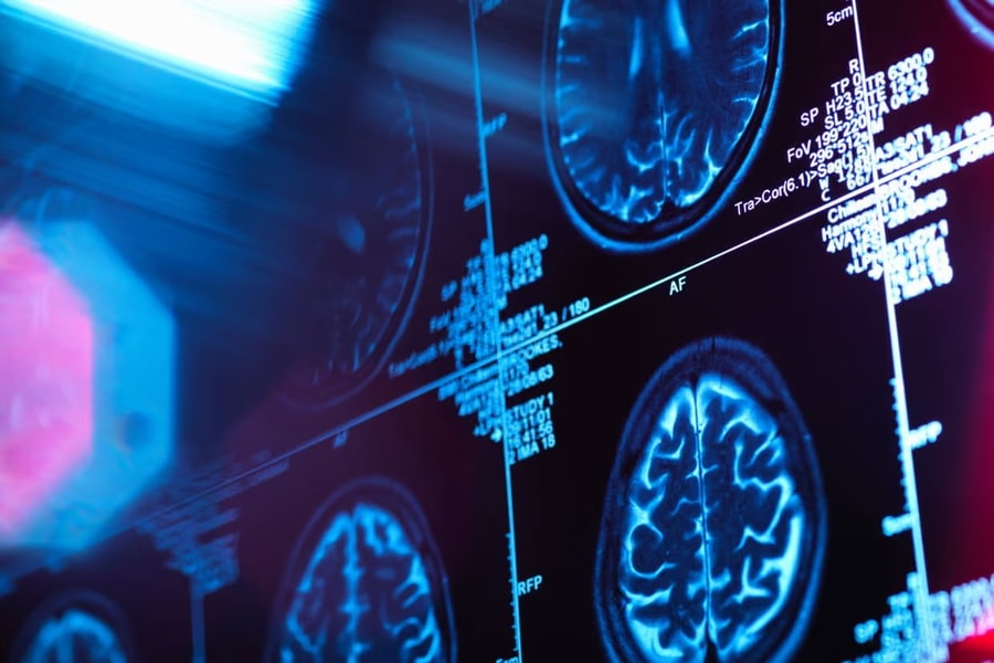 Hé lộ mối liên hệ giữa bất bình đẳng xã hội và cấu trúc não ở trẻ em