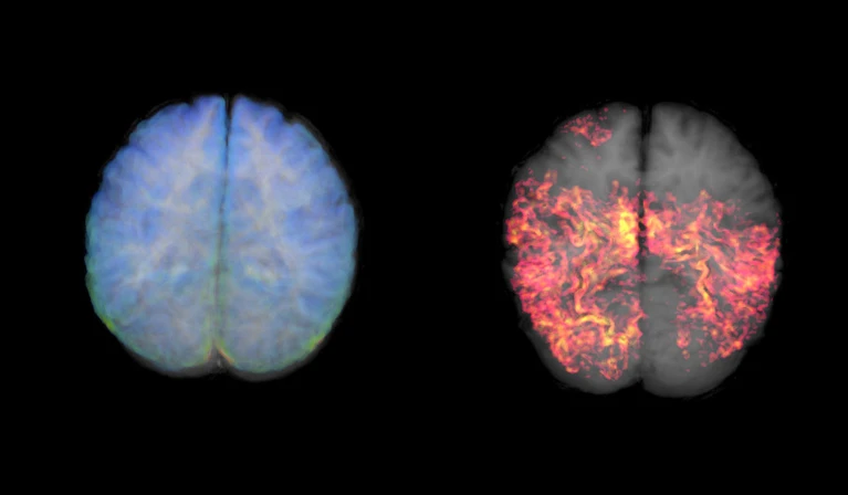 Xét nghiệm máu để hỗ trợ chẩn đoán Alzheimer‏